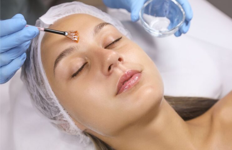 Peeling-quimico-facial