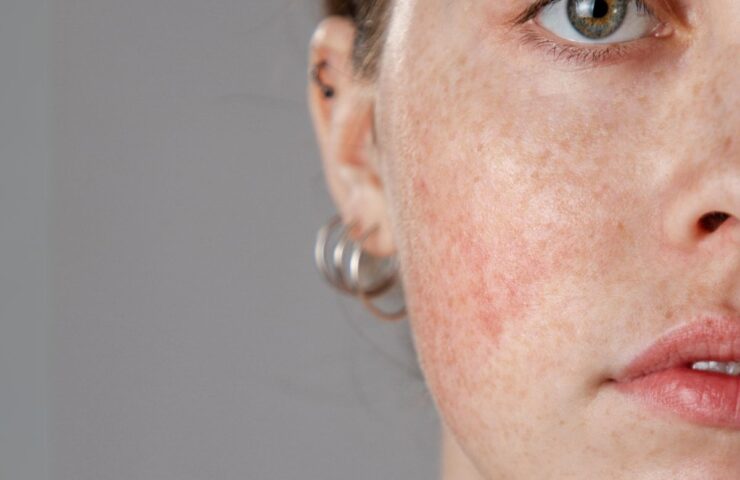 Rosacea