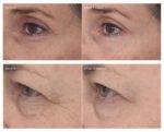 Retinal ReSculpt Eye Lift Treatment